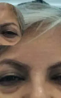 خدمات تزریق ژل و بوتاکس مزو