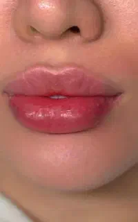 تزریق فیلر،بوتاکس،پی‌آرپی .تزریق چربی درکلینیک