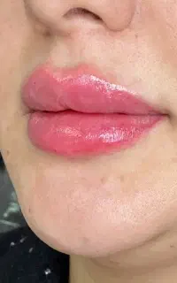 تخفیف ویژه فیلر، بوتاکس و آنزیم / پاکدشت
