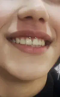خدمات پیرسینگ در مطب