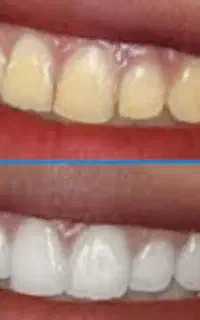 به راحتی دندان های خودراسفیدکنید