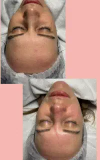 فیشال پاکسازی درمان لک جوش و اسکاراکنه