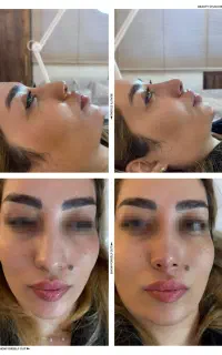 بوتاکس ژل لیفت نخ جراحی پلک چربی پی آرپی اندولیفت