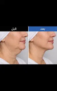 جوانسازی و‌کلاژن سازی پوست