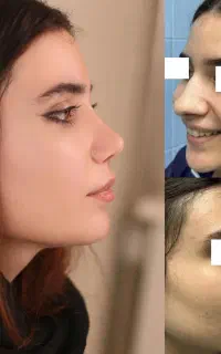 تغییر فرم چهره با رینوپلاستی نوین