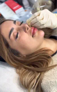 تخفیف ویژه تزریق ژل و بوتاکس تا اخر هفته