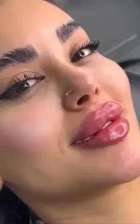 خدمات تخصصی فیلر و بوتاکس