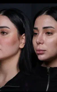 جشنواره، ساکشن،فیلر بادی،مزو،فیلرصورت  تخصصی