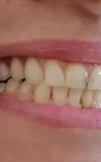 دندان تکه ای دونه ای ۵۰۰الی۷۰۰