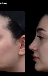 جراحی بینی خوش فرم فقط با۴۵میلیون
