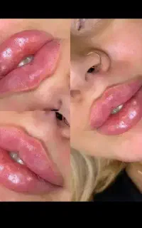 تزریق فیلر‌ و ژل لب و‌بوتاکس با آف ویژه فقط ۱ تومن