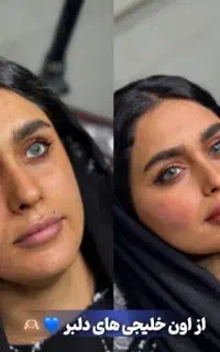 خطوط .فیلرلب .تغییر چهره،ژل،زاویه فک