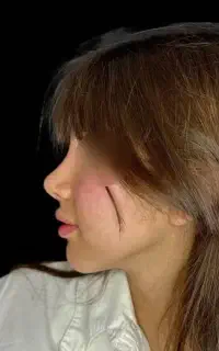ماموپلاستی عمل بینی لیپو ابدو