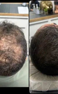 بدون خون ریزی و بخیه درمان شو