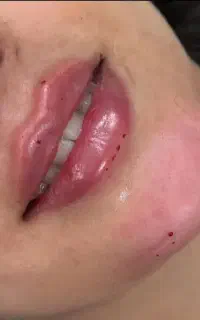 تزریق چربی و ساکشن، آموزش