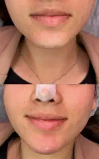 ژل و بوتاکس
