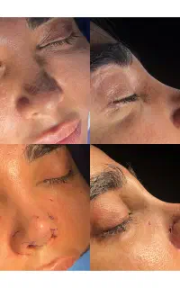 جراحی ها زیبایی با قیمت استثنایی (جراحی بینی۴۱م )