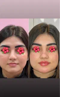 اف خدمات ‌و‌اموزشژل بوتاکس کراتین موخالبرداری پوست