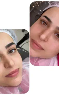 میکروبلیدینگ و شیدینگ اقساطی