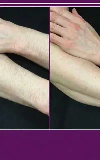 کیس شماره ۲ لیزر