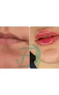 لیزر بوتاکس  ژل مزوتراپی توسط پزشک  در مسکن