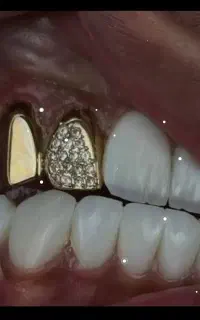 دندانپزشکی/ کامپوزیت دندان
