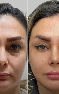 تزریق ژل و بوتاکس و مزو و آموزش حرفه ای