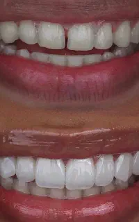 دندان پزشکی اوردنچر دوفک (اقساطی)