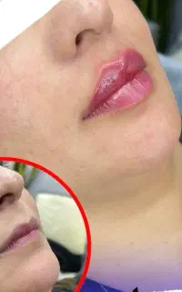 فیلر بوتاکس مزو PRP مزوژل کلینیک دکتر پیوند