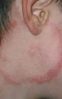 درمان قارچ پوستی با لیزر