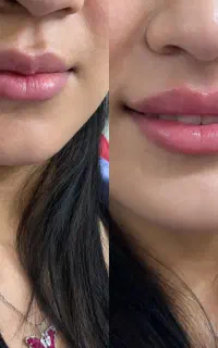 ژل و فیلر