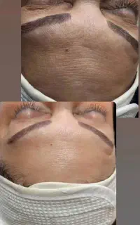 فشیال و پاکسازی و RF