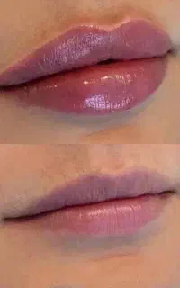جشنواره ژل و بوتاکس فیلر توسط خانم دکتر چابکی