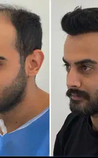 کاشت تخصصی مو و ابرو