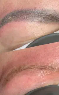 تخفیف 50% ریمو تتو ابرو با لیزر