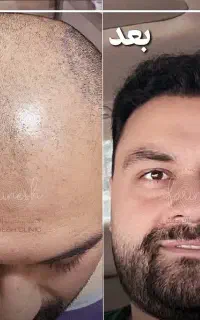 آموزش کاشت مو به شرط استخدام