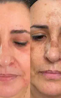 بیوممتیک/ قوی ترین کرم ضد لک / ارسال رایگان