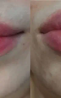 فیلر،بوتاکس،لیزر موهای زاید و جوانساز زیر نظر پزشک