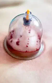 حجامت تخصصی و درمانی و ویژه و سم زدایی و پاکسازی