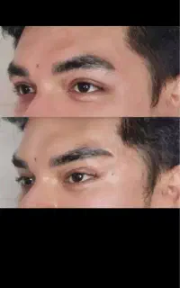 «دکتر کامبیز محمدپور»لیفت صورت بانخ«جوانساز کلاژن»