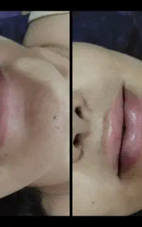 تزریقات اقتصادی فیلر،مزو،بوتاکس،چربی سوزی،آنزیم