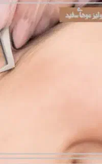 حذف کامل موهای صورت و بدن- روشن کننده دایمی بدن
