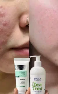 پک ضدجوش بیوممتیک