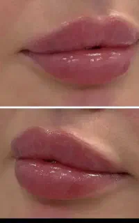کانتورینگ صورت فقط سیسی ۹۹۰توسط پزشک متخصص