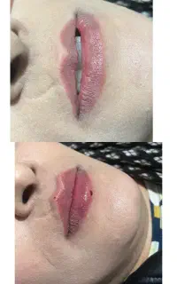 ژل و بوتاکس