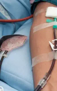 فصد خون حجامت و خدمات پرستاری