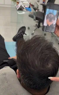 رویش مجدد مو و ریش و قطع ریزش