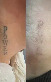 خدمات ریمو تتو و لیزر کک مک در کلینیک دکتر شریفی