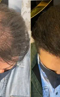 میکرواسکالپ مو