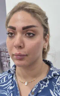 جشنواره تخفیف یک هفته ای تزریق فیلر